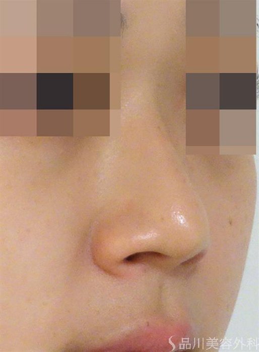 症例NO.44654のAFTER写真