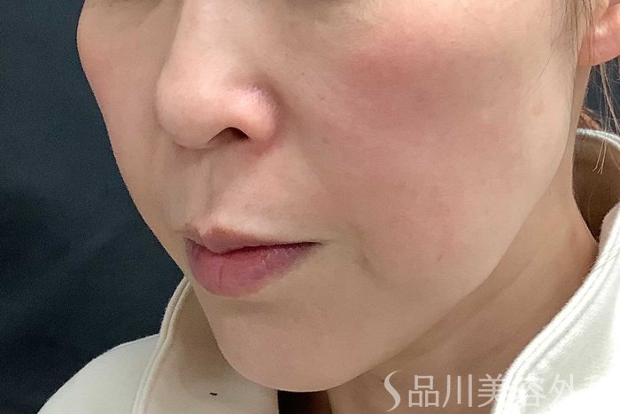 症例NO.62965のBEFORE写真