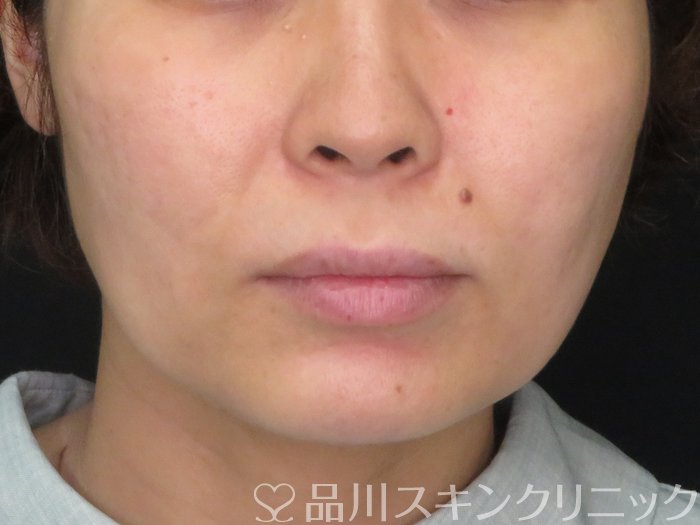 症例NO.74784のBEFORE写真