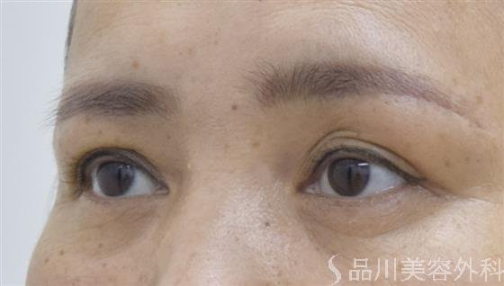 症例NO.53281のAFTER写真