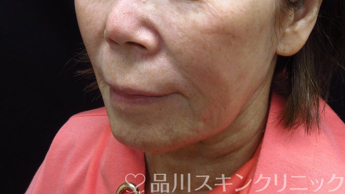 症例NO.73202のBEFORE写真