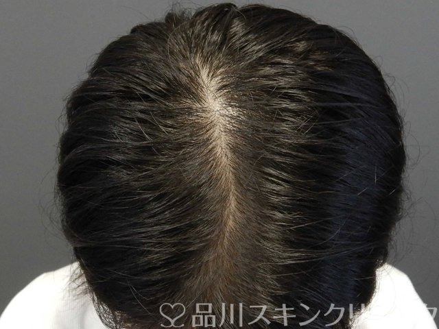 症例NO.69113のBEFORE写真