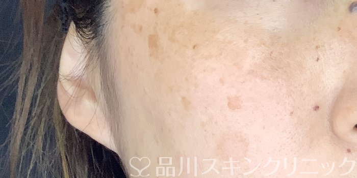 症例NO.70186のAFTER写真