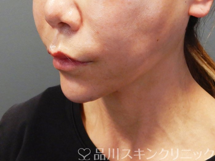 症例NO.72812のAFTER写真