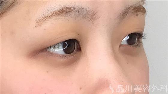 症例NO.60097のBEFORE写真