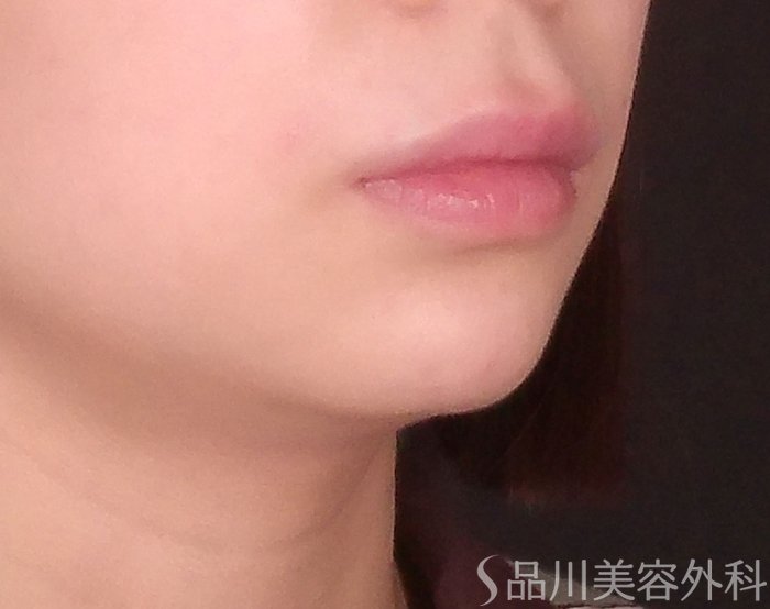 症例NO.70561のAFTER写真