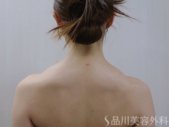 症例NO.74530のAFTER写真