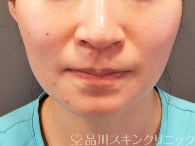 症例NO.70315のBEFORE写真