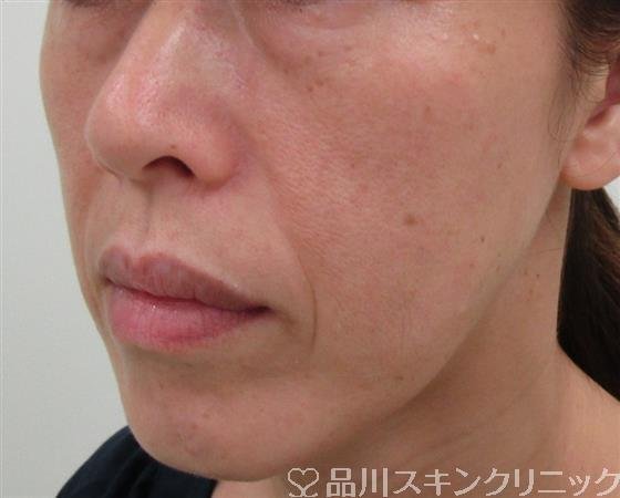 症例NO.31214のBEFORE写真