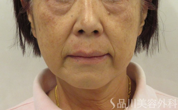 症例NO.71165のBEFORE写真