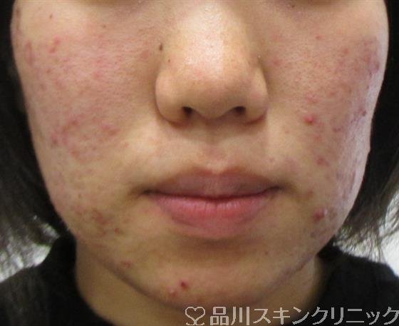 症例NO.42869のBEFORE写真