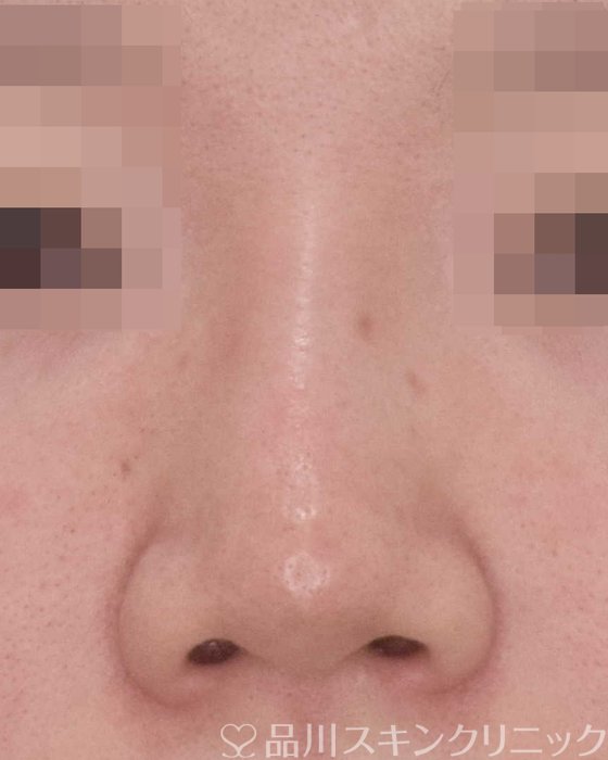 症例NO.67652のBEFORE写真