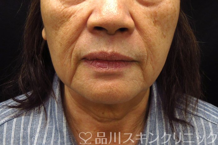 症例NO.74712のBEFORE写真