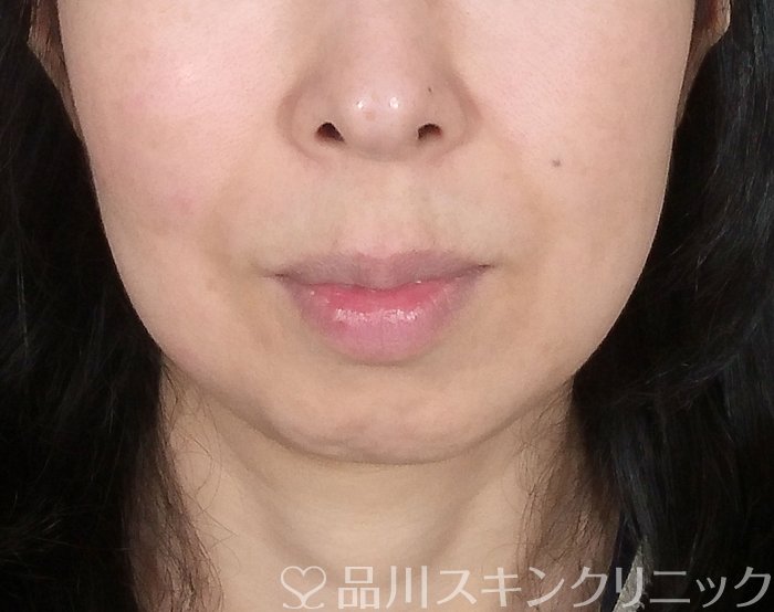 症例NO.69647のBEFORE写真