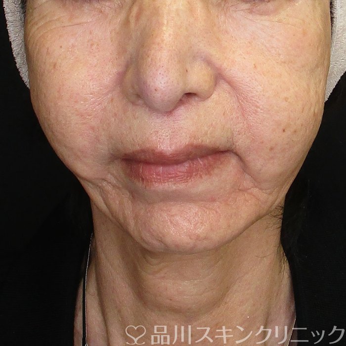 症例NO.75054のBEFORE写真
