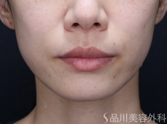 症例NO.73824のBEFORE写真