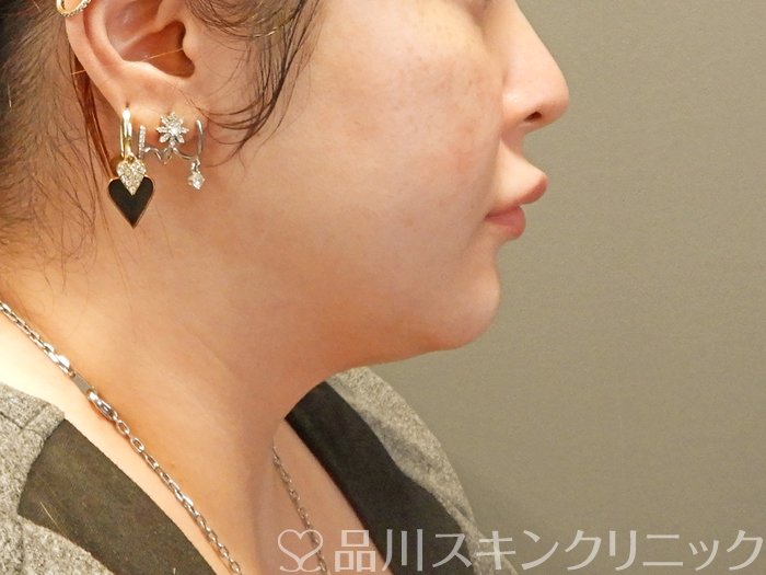 症例NO.67477のAFTER写真