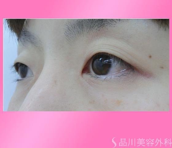 症例NO.14204のBEFORE写真
