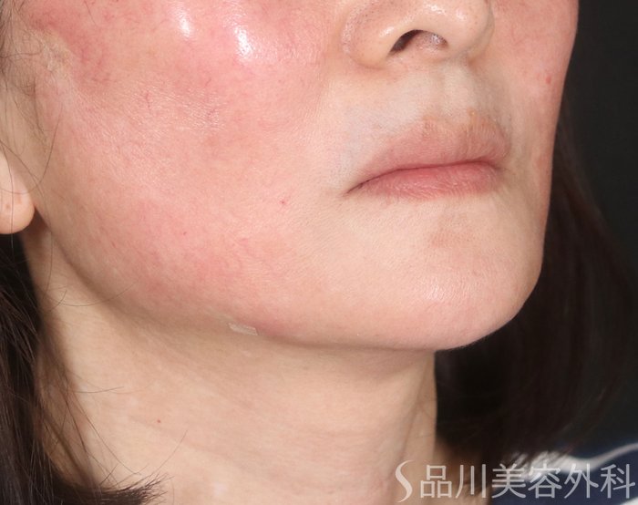 症例NO.73552のAFTER写真