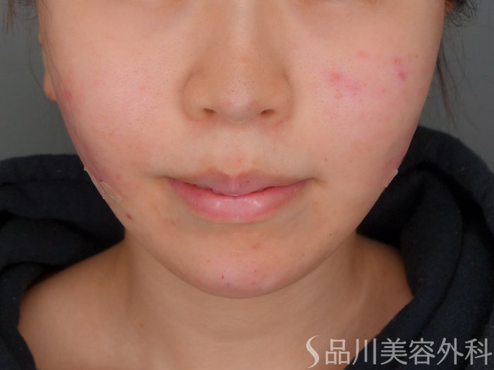 症例NO.73178のAFTER写真