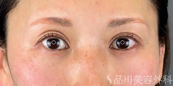 症例NO.70306のBEFORE写真