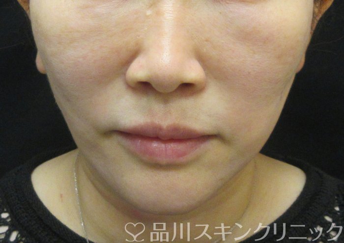 症例NO.73953のAFTER写真