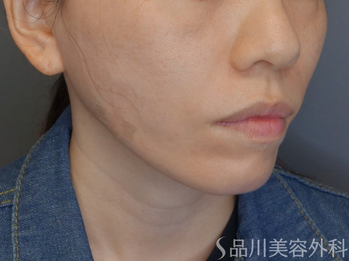 症例NO.71646のAFTER写真
