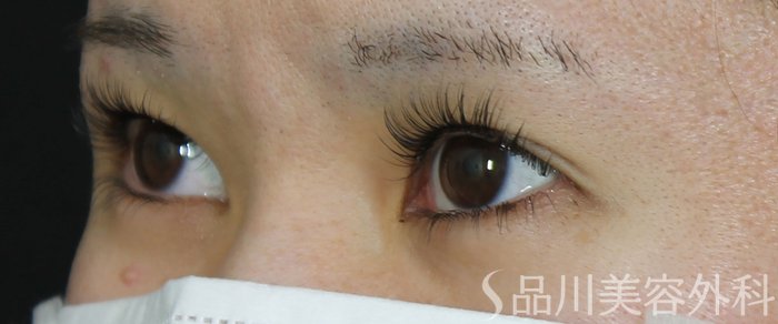 症例NO.72114のBEFORE写真