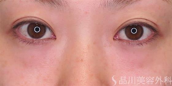 症例NO.46690のBEFORE写真
