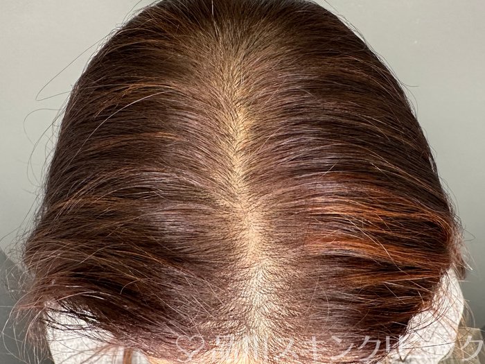 症例NO.73413のAFTER写真