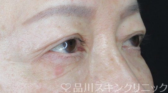 症例NO.69533のAFTER写真