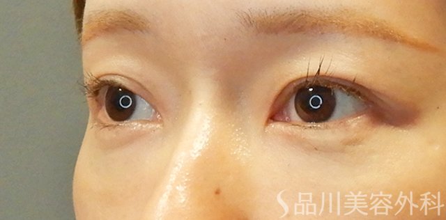 症例NO.67709のBEFORE写真