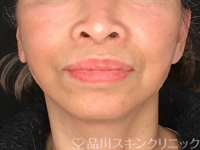 症例NO.65006のAFTER写真