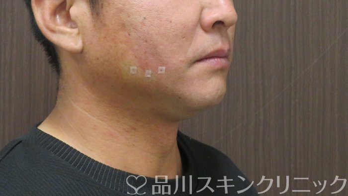 症例NO.72371のAFTER写真