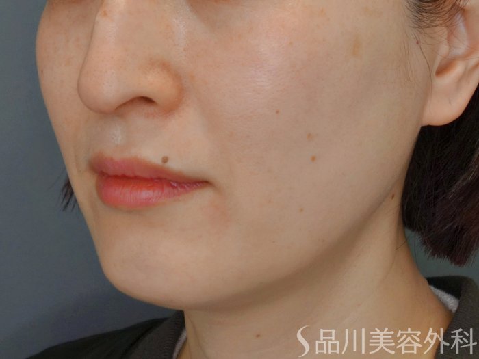 症例NO.73484のBEFORE写真