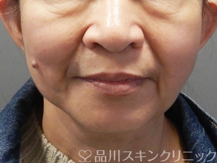 症例NO.73522のBEFORE写真
