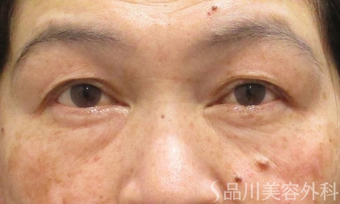 症例NO.70563のBEFORE写真