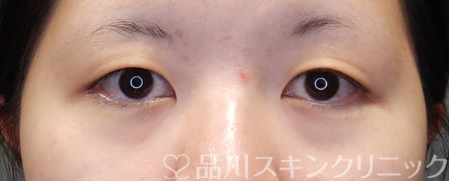 症例NO.74493のBEFORE写真