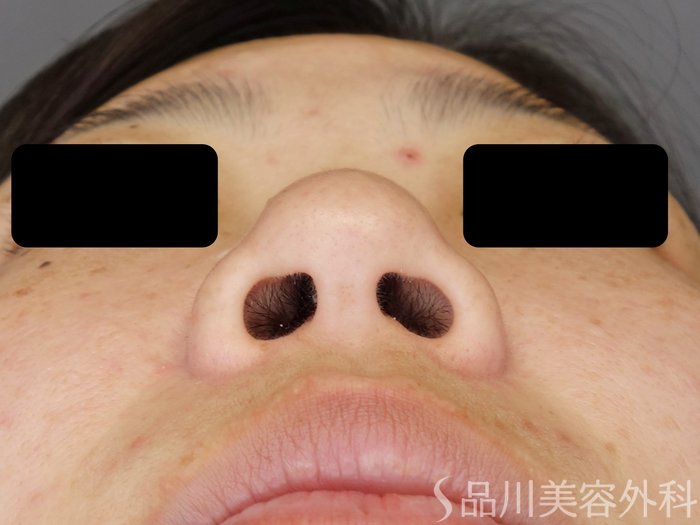 症例NO.71433のBEFORE写真