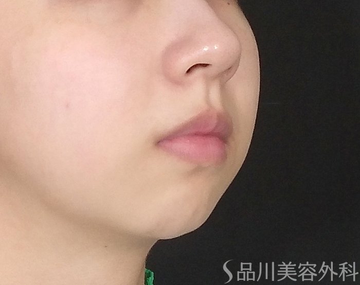 症例NO.71688のBEFORE写真