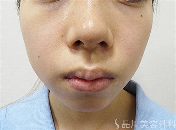 症例NO.52024のBEFORE写真