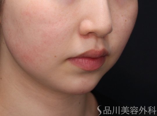 症例NO.71825のBEFORE写真