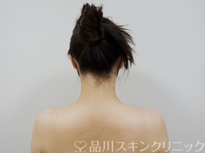 症例NO.73137のAFTER写真