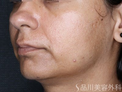 症例NO.71539のAFTER写真