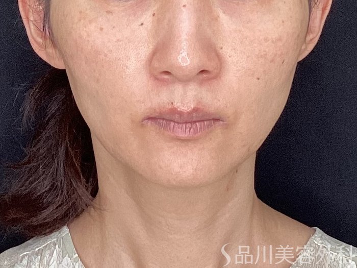 症例NO.62359のBEFORE写真