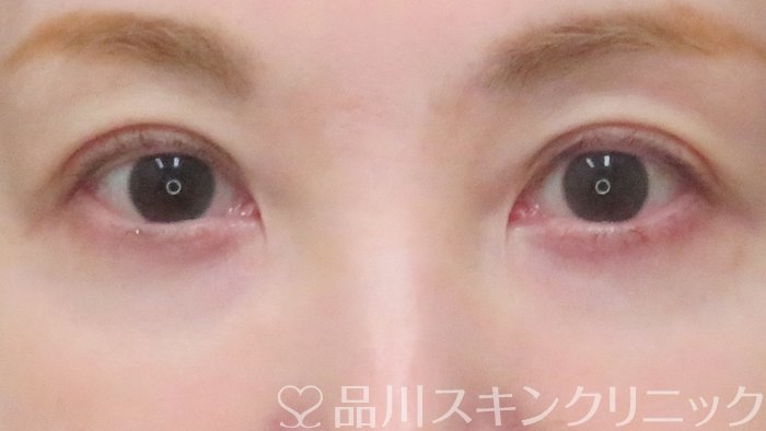 症例NO.71667のAFTER写真