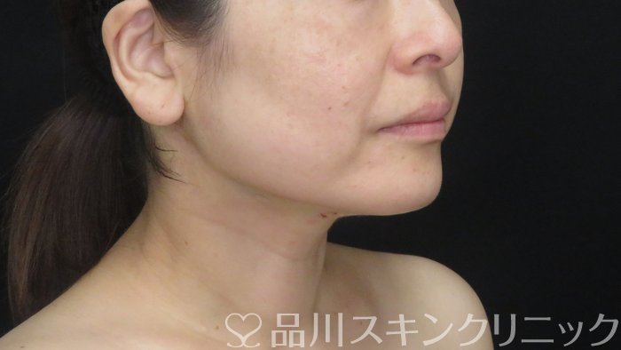 症例NO.71575のAFTER写真