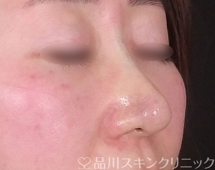 症例NO.68544のAFTER写真
