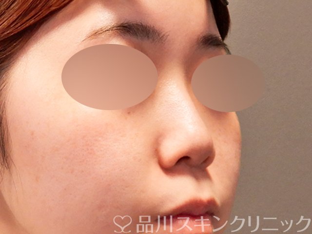 症例NO.71486のBEFORE写真