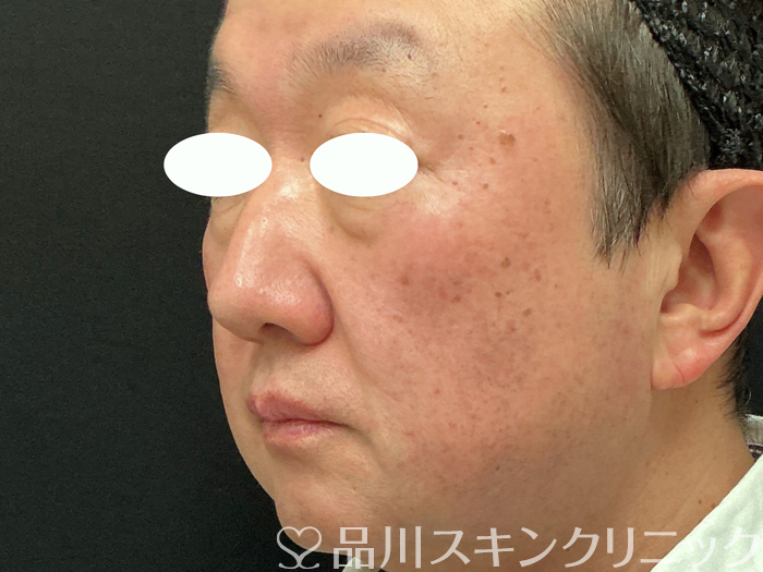 症例NO.74029のBEFORE写真